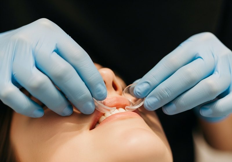 Tandblekning utförs med skena på en patient