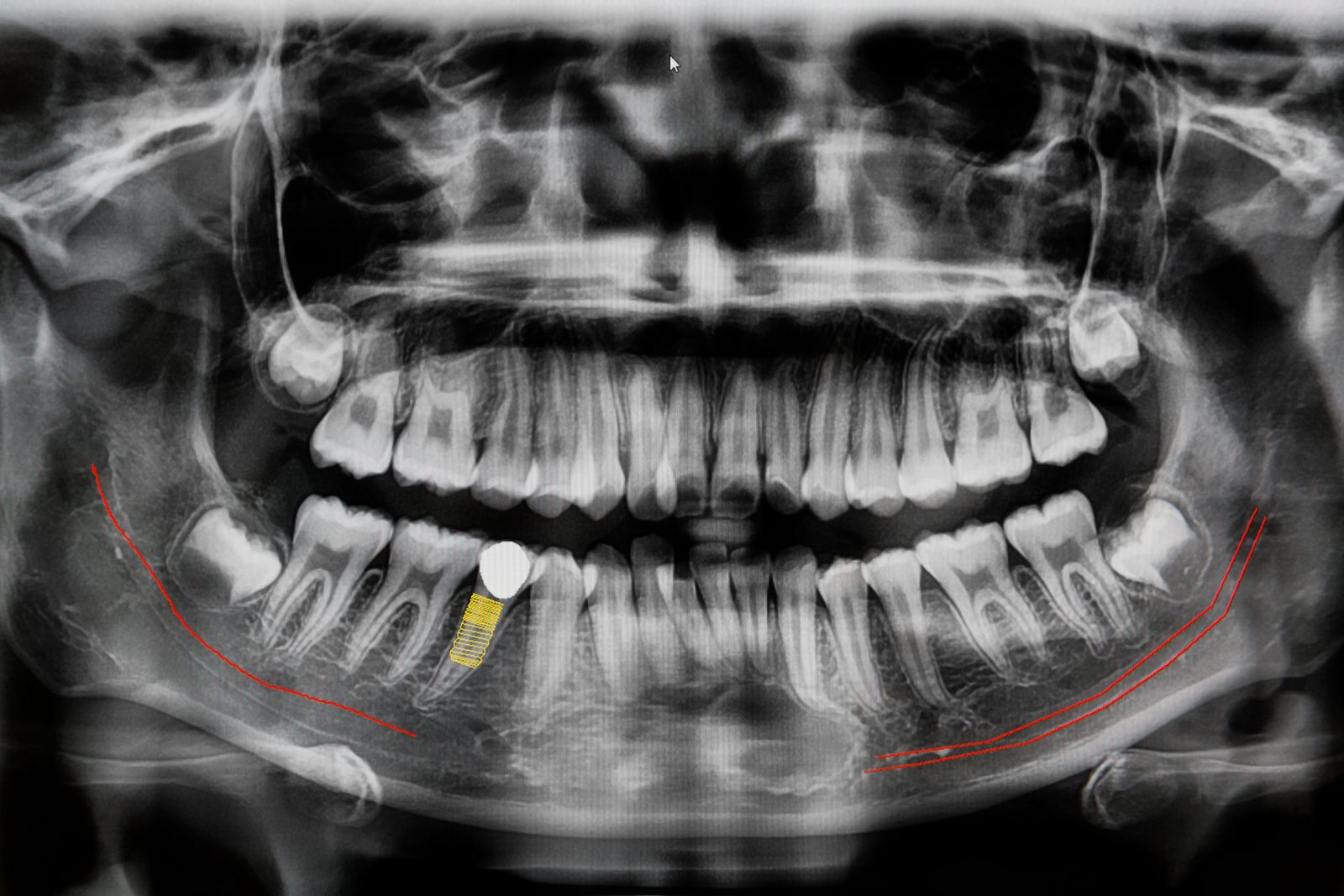 Panoramaröntgen av en tandrad med markerade implantat